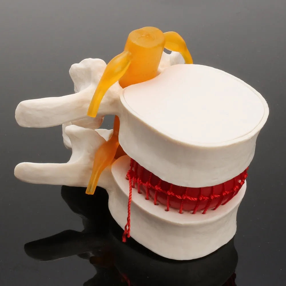 White PVC anatomical model of a herniated human lumbar intervertebral disc for medical demonstration