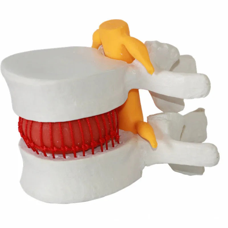 White PVC anatomical model of a herniated human lumbar intervertebral disc for medical demonstration