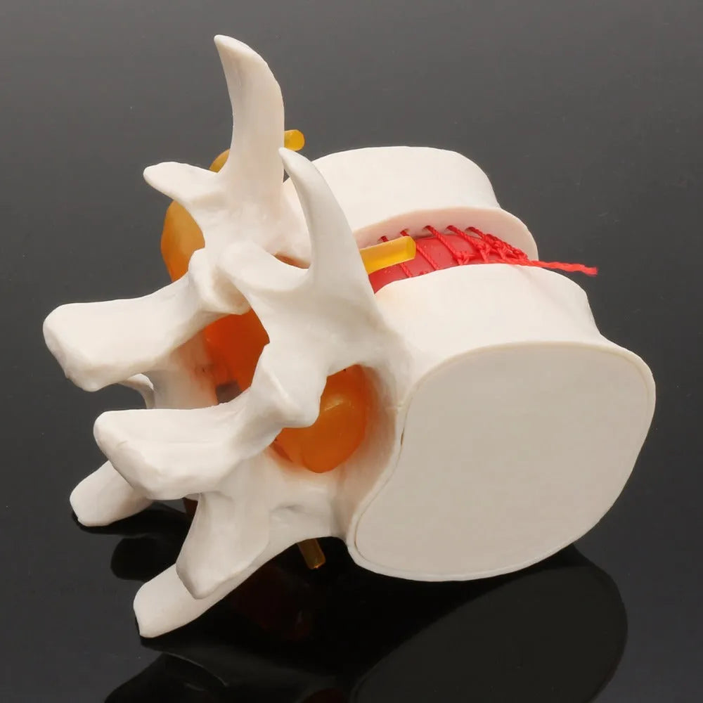 White PVC anatomical model of a herniated human lumbar intervertebral disc for medical demonstration