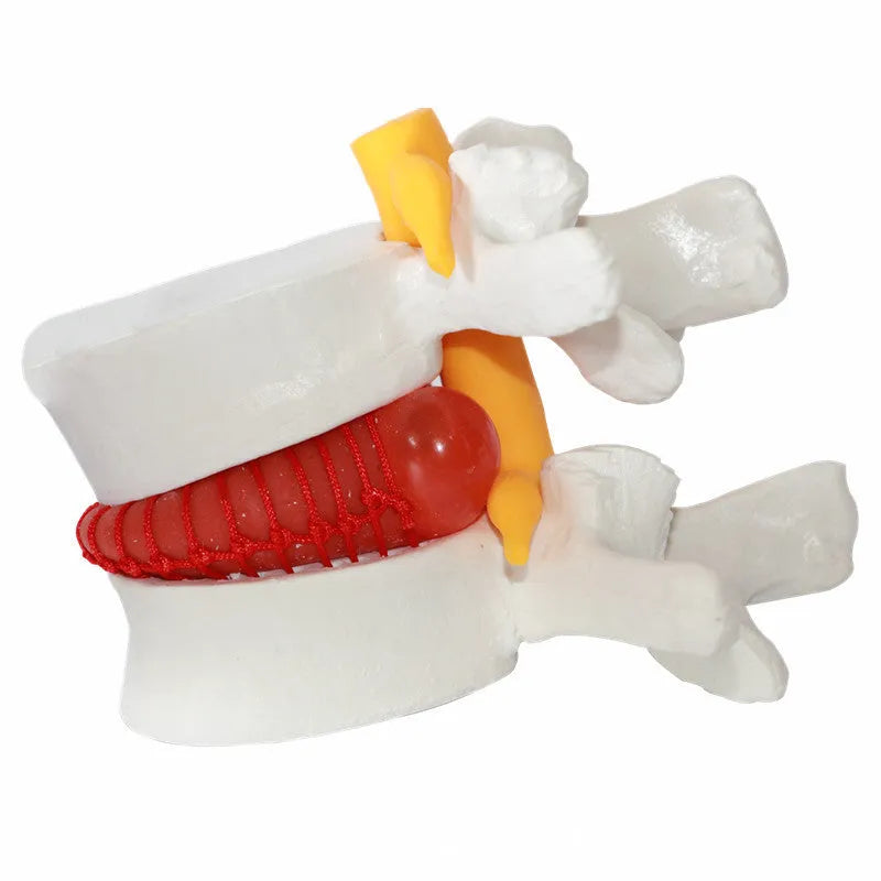 White PVC anatomical model of a herniated human lumbar intervertebral disc for medical demonstration