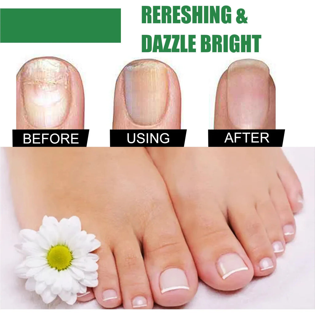 30ml bottle of tea tree oil nail repair solution for hand and foot nail care