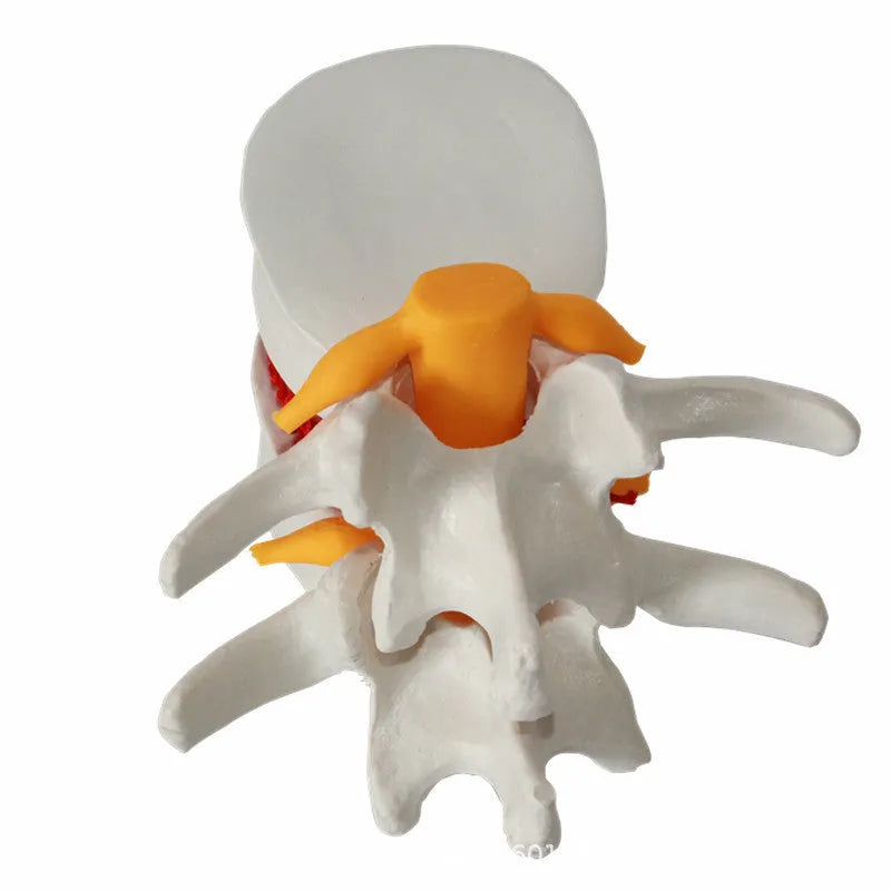 White PVC anatomical model of a herniated human lumbar intervertebral disc for medical demonstration
