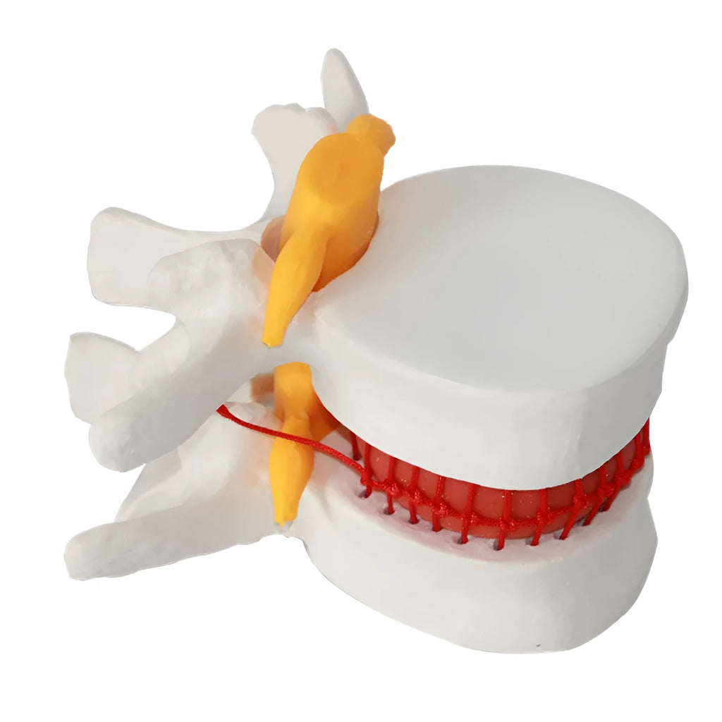 White PVC anatomical model of a herniated human lumbar intervertebral disc for medical demonstration