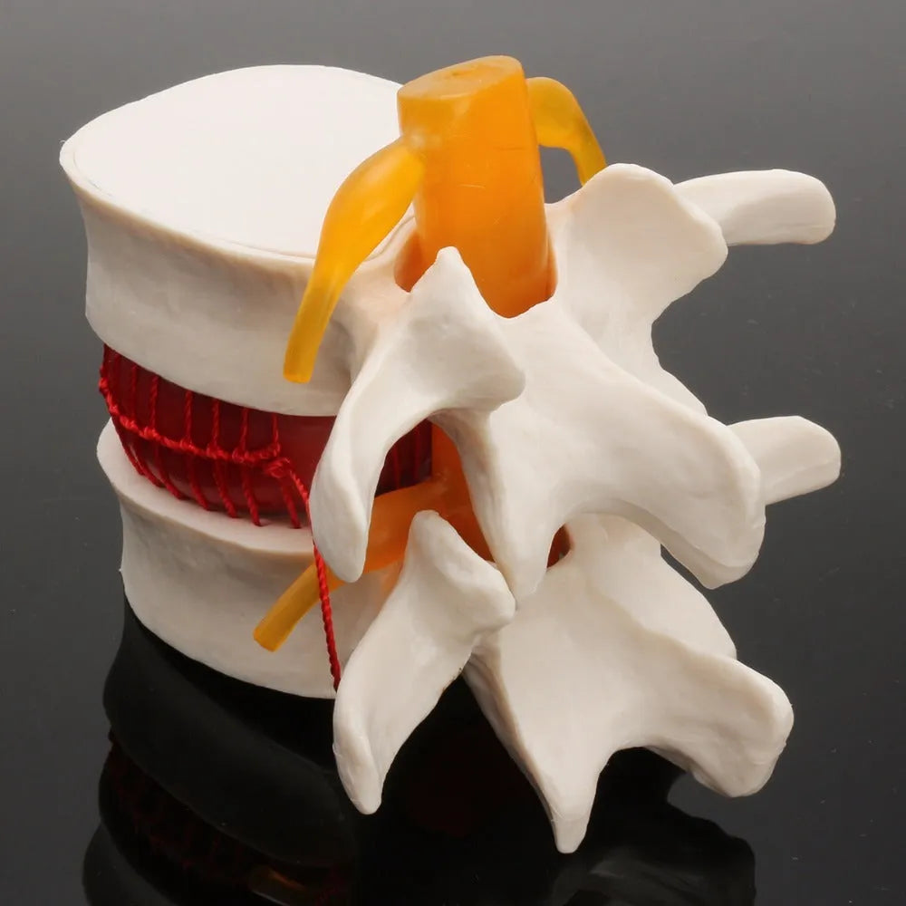 White PVC anatomical model of a herniated human lumbar intervertebral disc for medical demonstration