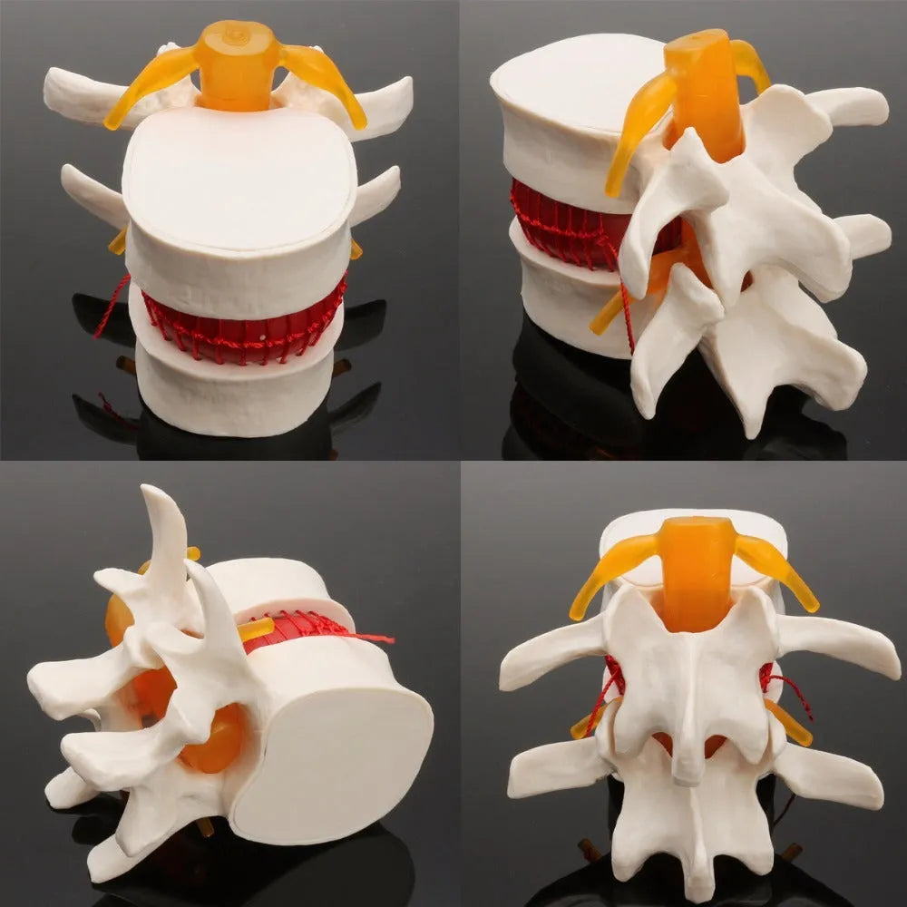 White PVC anatomical model of a herniated human lumbar intervertebral disc for medical demonstration