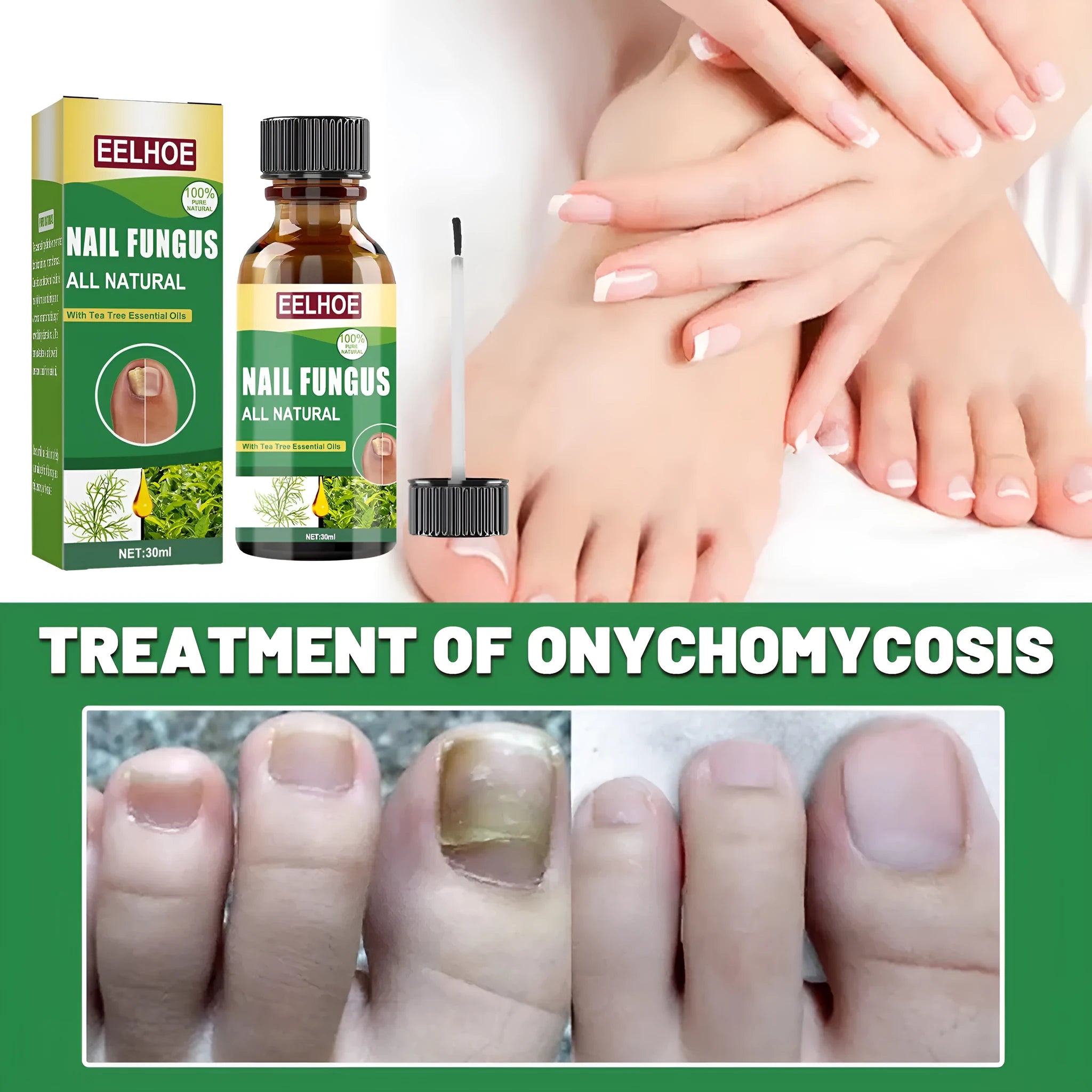 30ml bottle of tea tree oil nail repair solution for hand and foot nail care