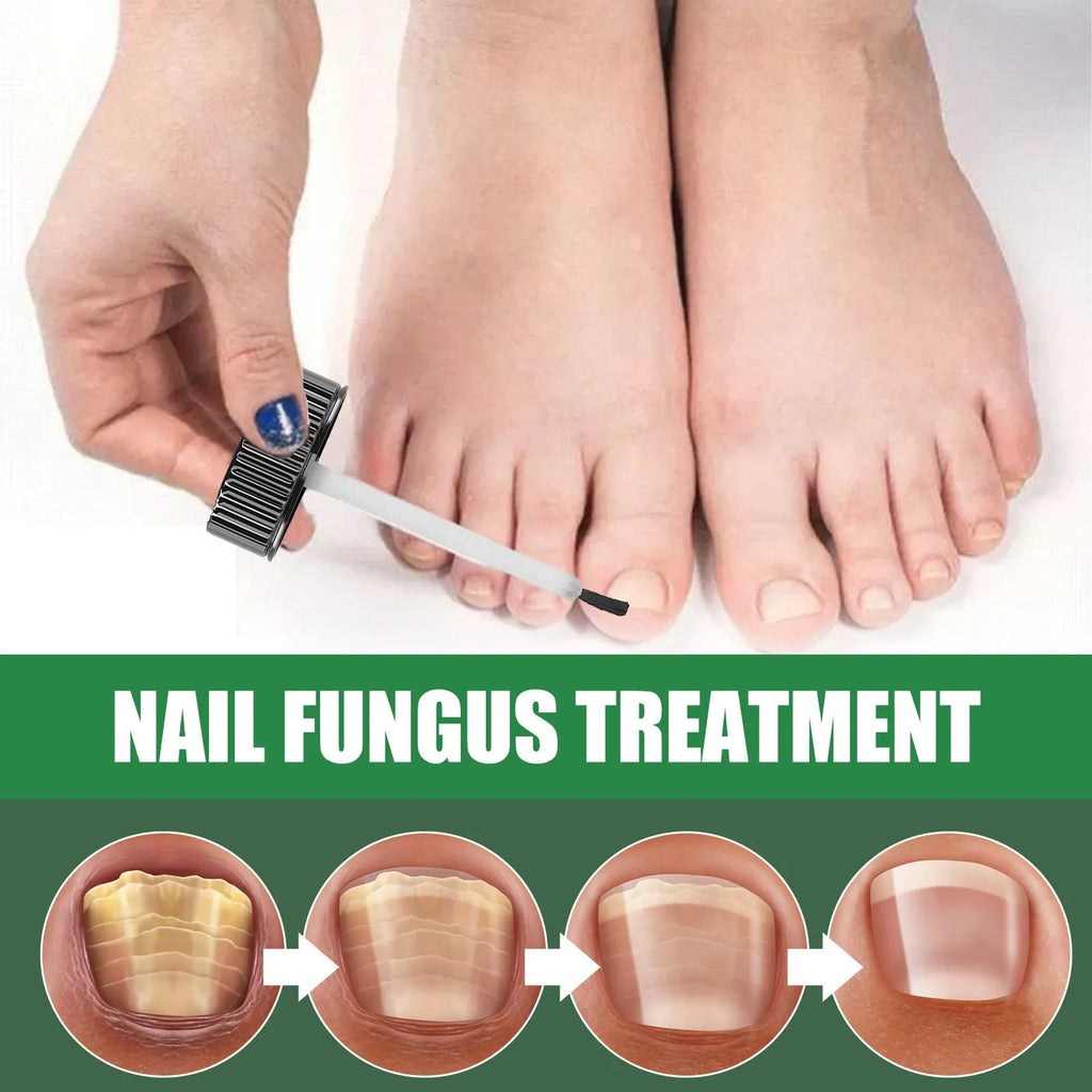 30ml bottle of tea tree oil nail repair solution for hand and foot nail care